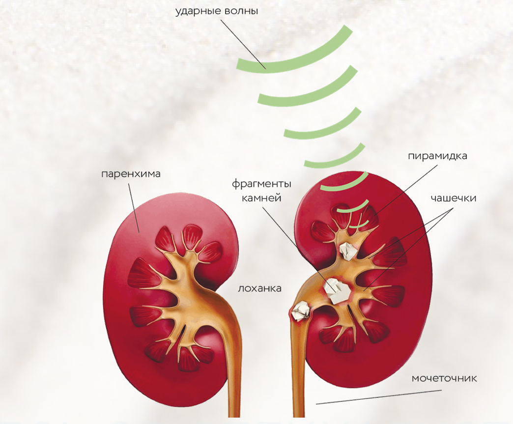 Диета После Дробления Камней В Почках