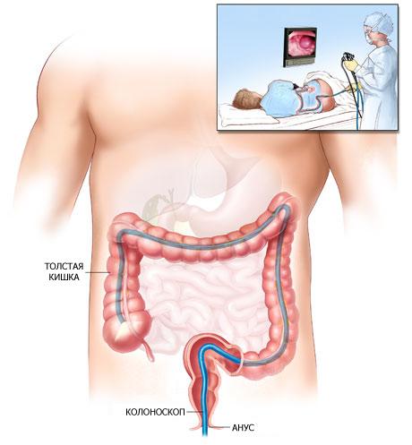 Видеоректосигмоколоноскопия 