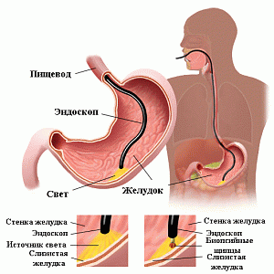 Видеоэзофагогастродуоденоскопия