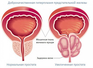 Доброкачественная гиперплазия предстательной железы (Аденома простаты)