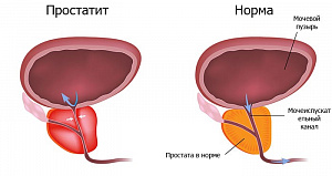 Расширенный урологический онко-поиск (исключение метастазирования)