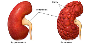 Киста почки