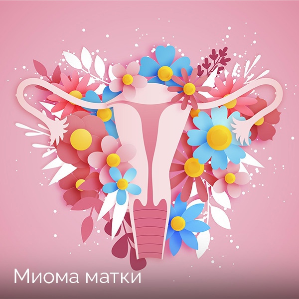 Миома матки