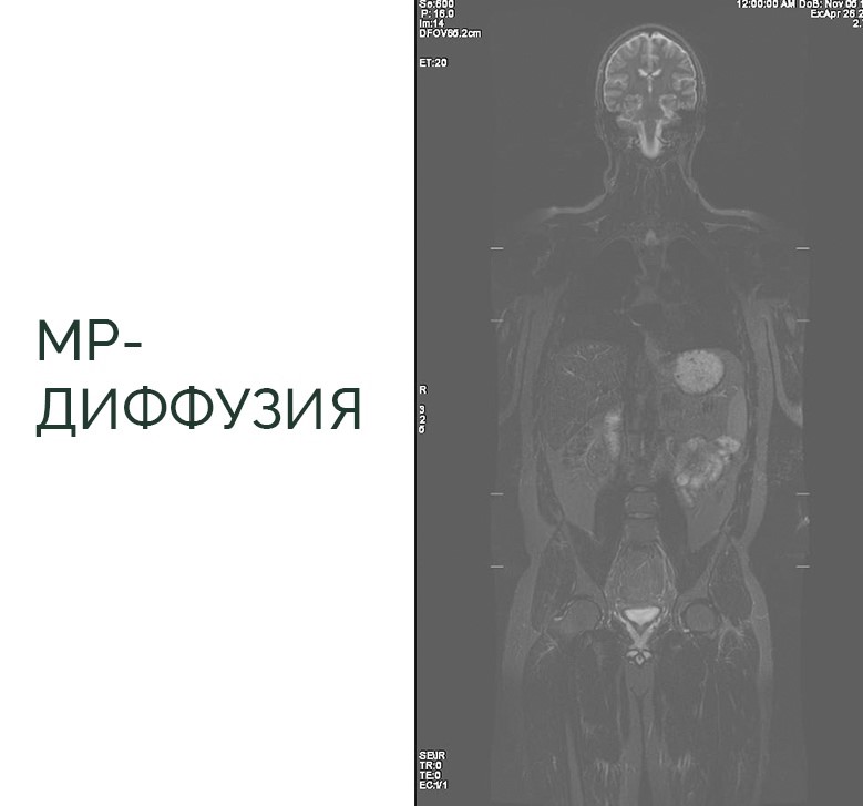 МРТ всего тела