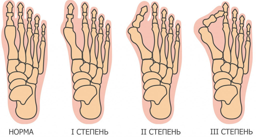 Вальгусная деформация стоп