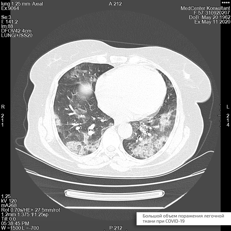 lung2